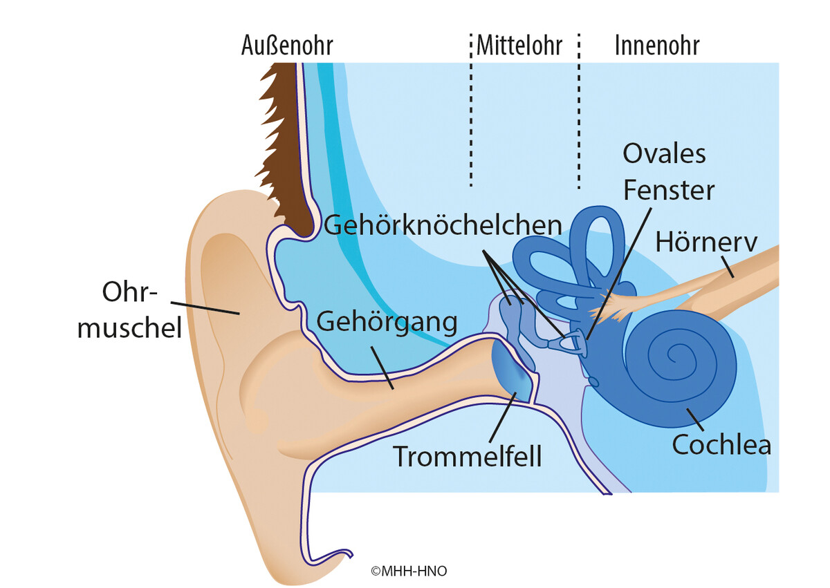 Die Grafik zeigt die Anatomie des Ohres mit Ohrmuschel und Gehörgang; das Mittelohr mit Trommelfell, Gehörknöchelchen und ovalem Fenster; das Innenohr mit Cochlea und Hörnerv.
