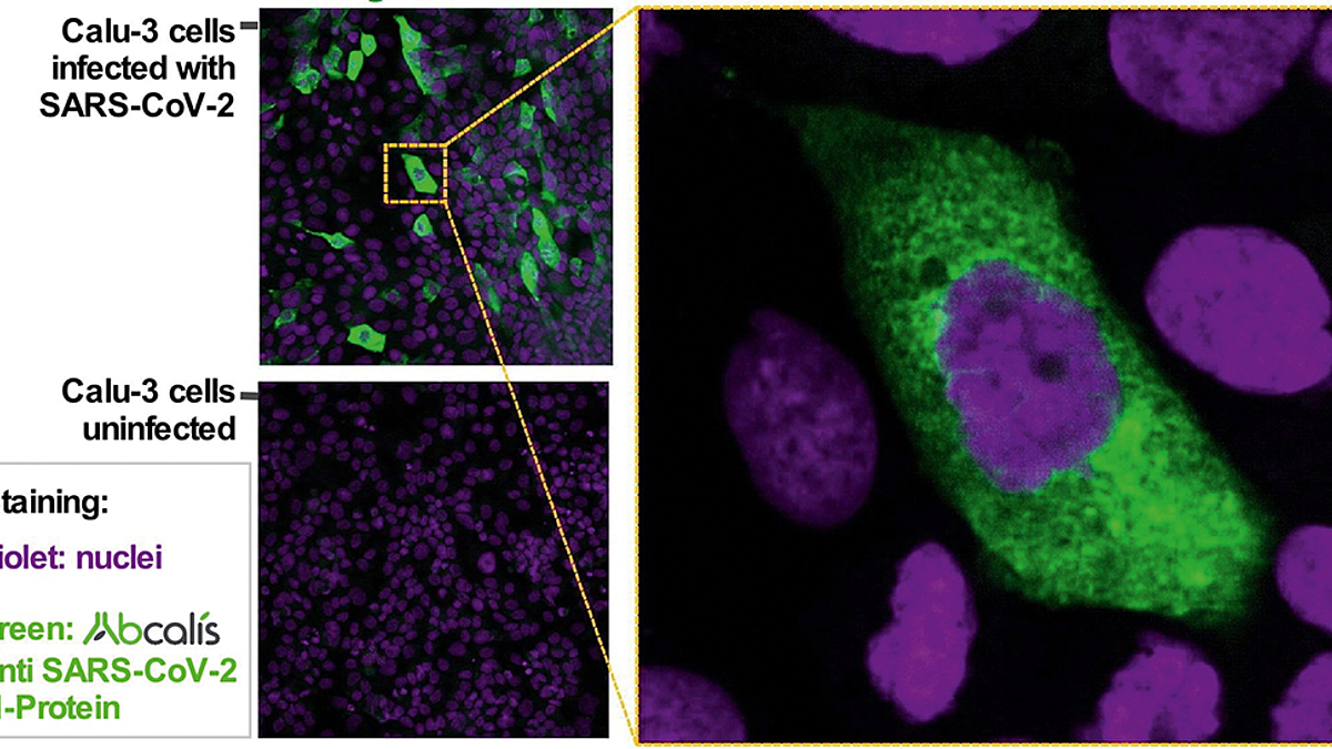 Mikroskopische Aufnahme von Zellen, von denen einige mit dem Corona-Virus infiziert sind.